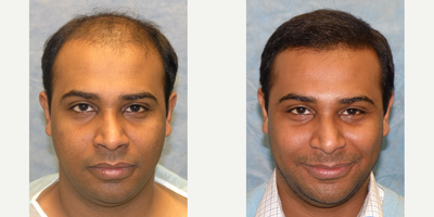 Hair Loss Treatment before and after photo