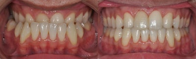 Jaw Surgery before and after photo