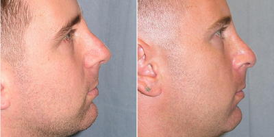 Rhinoplasty before and after photo