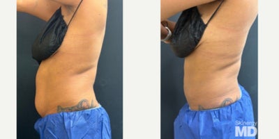 BodyTite before and after photo