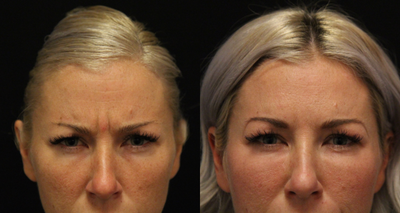 Botox before and after photo