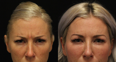Botox before and after photo