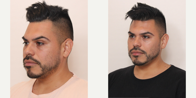 Cheek Augmentation before and after photo