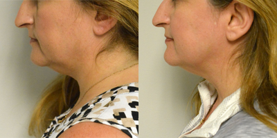 Kybella before and after photo