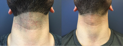Laser Hair Removal before and after photo