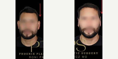 Ear Surgery before and after photo