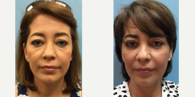 Eyelid Surgery before and after photo