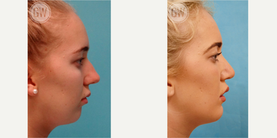 Genioplasty before and after photo