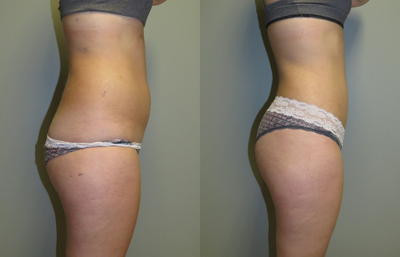 Liposuction before and after photo