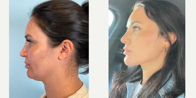 Morpheus8 before and after photo