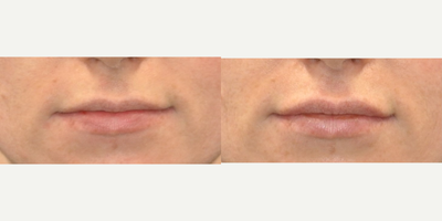 Juvederm before and after photo