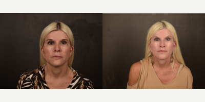 Neck Lift before and after photo