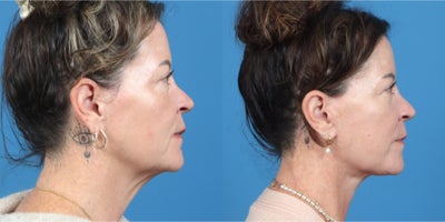 Neck Lift before and after photo