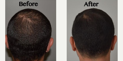 PRP for Hair Loss before and after photo
