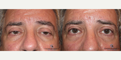 Ptosis Surgery before and after photo