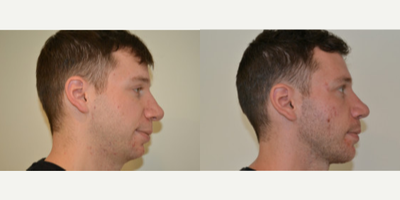 Chin Implant before and after photo