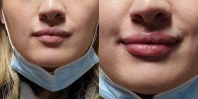 Dermal Fillers before and after photo
