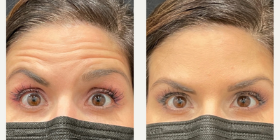 Dysport before and after photo