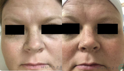 IPL before and after photo