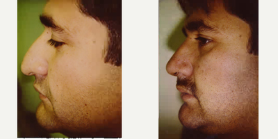 Rhinoplasty before and after photo