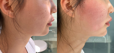 Thread Lift before and after photo