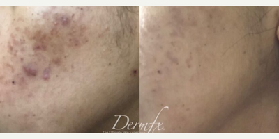 Agnes RF before and after photo