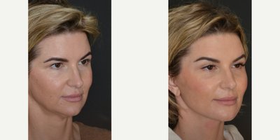 Facelift before and after photo
