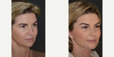 Facelift before and after photo