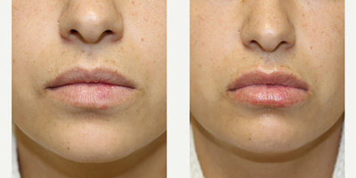 Lip Fillers before and after photo