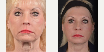 Facelift before and after photo