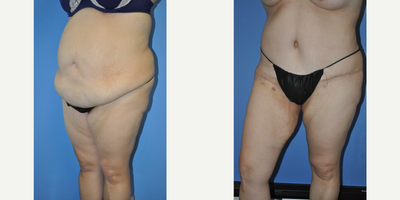 Tummy Tuck before and after photo