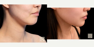 Deep Plane Facelift before and after photo