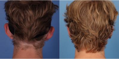 Ear Surgery before and after photo