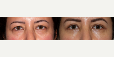 Eyelid Surgery before and after photo