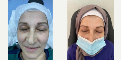 Eyelid Surgery before and after photo