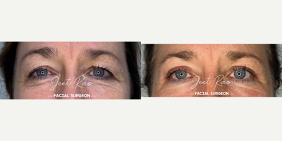 Eyelid Surgery before and after photo