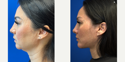 Facelift before and after photo