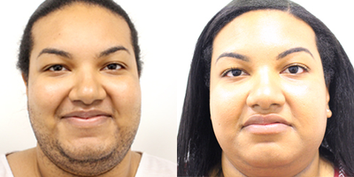 Laser Hair Removal before and after photo