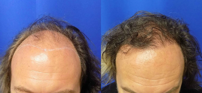 NeoGraft before and after photo
