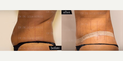Tummy Tuck before and after photo