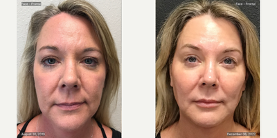 Dermal Fillers before and after photo