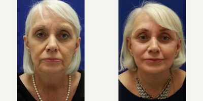 Facelift before and after photo