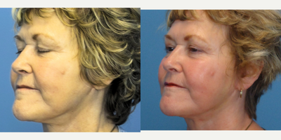 Facelift before and after photo