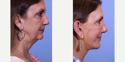Facelift before and after photo