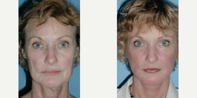 Facelift before and after photo