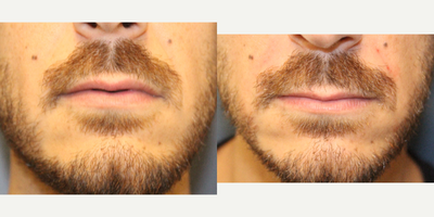 Juvederm before and after photo