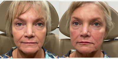 Lip Fillers before and after photo