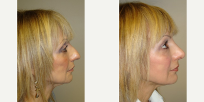 Rhinoplasty before and after photo