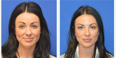 Botox before and after photo