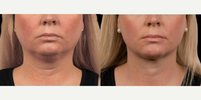CoolSculpting before and after photo